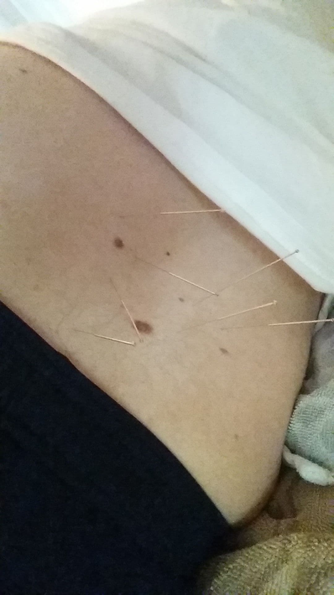 용인 동백 자연한의원 복부 침 치료 과민성대장증후군